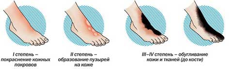 От ожога первая помощь яйцом