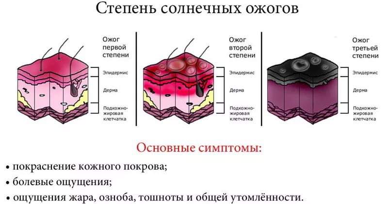 Степени солнечных ожогов