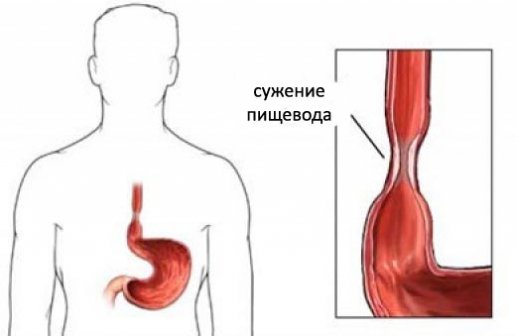От чего возникает ожог пищевода