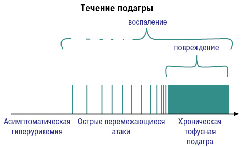 Течение подагры Течение подагры