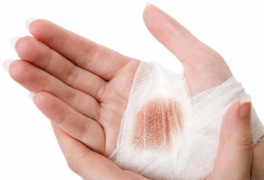 лопнувший термический ожог на руке