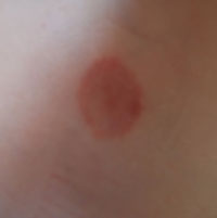 Что делать, когда наблюдается появление небольших пятен, похожих на ожог