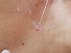 Удаление папилломы лазером, красный огонек, дым, запах.