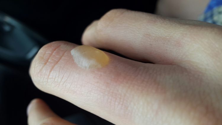 Нужно ли лопать волдырь при ожоге