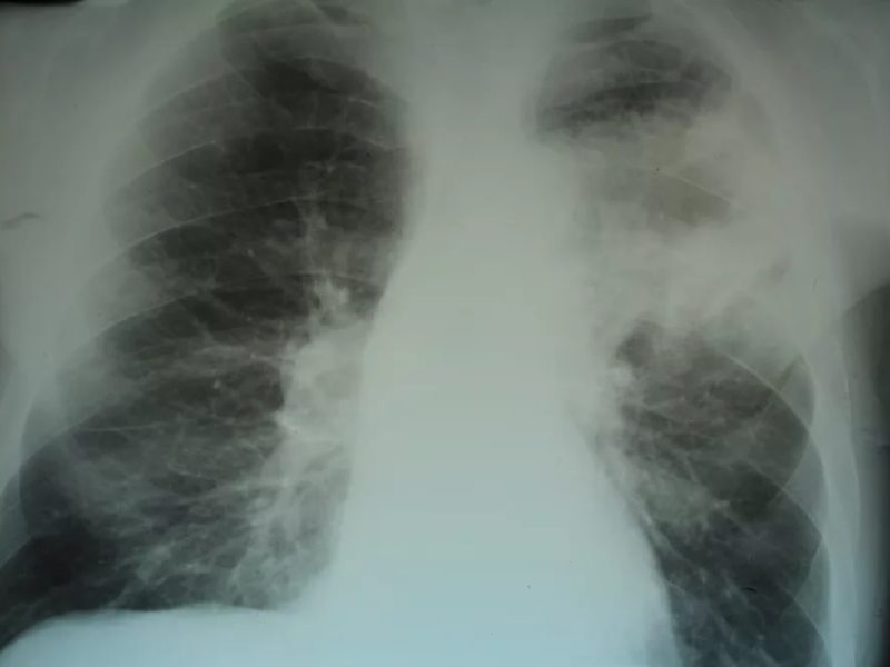 Пневмония на снимке рентгена Симптомы пневмонии