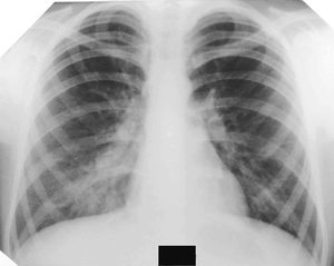 С чем чаще всего путают пневмонию Лечение заболевания пневмонии